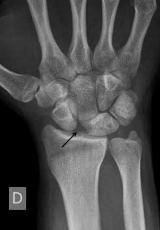 Lesión del Ligamento Escafo-Lunar, se puede ver una separación anormal entre ambos huesos