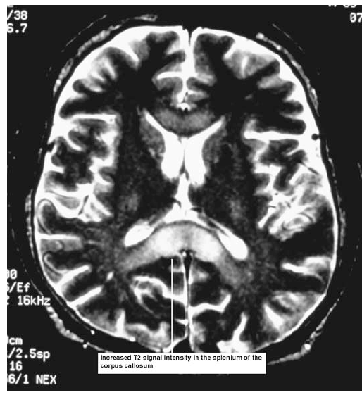 Imagen de una Resonancia Magnética de cerebro, donde se pueden observar signos de ECA